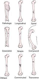 Comminuted Fracture Comminated Bone Fracture Treatment Medical Dictionary Medical Anatomy Medical Knowledge