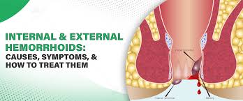 Image result for hemorrhoids