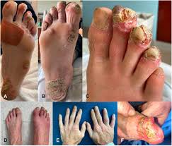 Educational image placeholder: heel pain and enthesitis in reactive arthritis