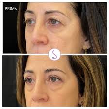 𝗕𝗹𝗲𝗳𝗮𝗿𝗼𝗽𝗹𝗮𝘀𝘁𝗶𝗰𝗮 𝗦𝘂𝗽𝗲𝗿𝗶𝗼𝗿𝗲 -...