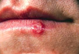 Discrete ulcers or ulcers with vesicles, bullae, or pseudomembranes. Herpes Simplex Virus Infections Amboss