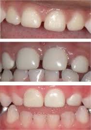 Three Examples Of Esthetic Restorations For Primary Anterior Dentition Composite Strip Crowns A Preveneered Sta Restorative Dentistry Dentistry Restoration