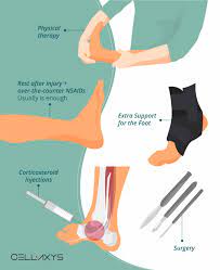 How To Decrease Your Posterior Tibial Tendonitis Recovery Time Cellaxys