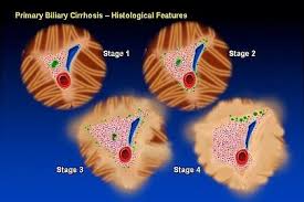 Primary Biliary Cirrhosis Causes Symptoms Diagnosis And Treatment Cirrhosis Liver Health Liver Problems