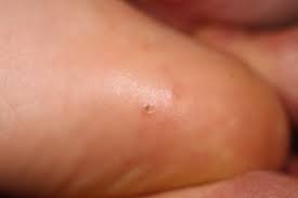 natural remes for warts an