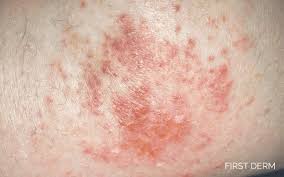 Image result for contact dermatitis