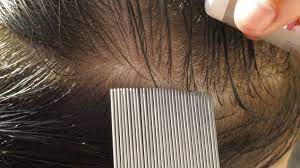 Lause Lause Erkennen Lausemittel Shampoo Co Onmeda De
