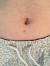 Ingrown Hair On Stomach Won T Go Away