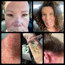 Has anyone developed a bad rash from Eliquos? I started getting a bad rash  about 35 days in and it just keeps getting worse. I have changed nothing  else. It looks almost