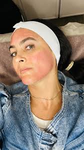 ✨TODAY’S SKIN ADVENTURE: MICRONEEDLING✨, Tiny needles, big results! 10/10  recommended treatment! Come with me to @myethos360 to see Microneedling  magic in action! ✨ First, we applied numbing cream to ...