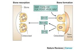 Being armed with information is vital to begin the fight. Osteoblasts In Prostate Cancer Metastasis To Bone Nature Reviews Cancer