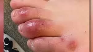 Maybe you would like to learn more about one of these? Researchers Say Skin Rashes Should Be Considered 4th Symptom Of Covid 19 Abc13 Houston