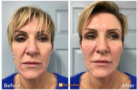 Thread lift before and after jowls. The Grove Clinic X Lift