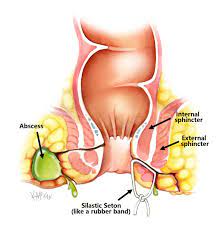Check spelling or type a new query. Fistula Repair Colorectal Surgeons Sydney