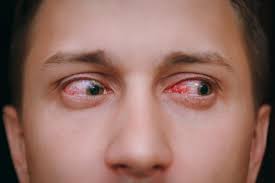 Red Eyes: Home Remedies And Health Tips