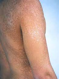 D'autres fois, le cercle forme une plaque de peau sèche et uniforme. Pityriasis Versicolor