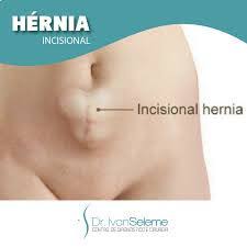 Hernia Abdominal Dr Pablo Hubner Cirurgias