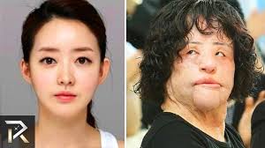 Google Celebrity Plastic Surgery Plastic Surgery Gone Wrong Botched Plastic Surgery