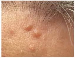 Image result for Papule