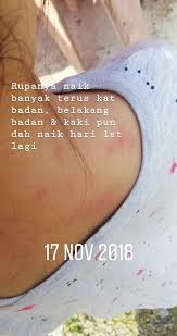 Jika anda seorang pemula dan ingin tahu tentang cara merawat kucing, berikut adalah beberapa tips dasar dari boldsky.com. Anak Kena Chicken Pox Kering Dalam Masa Empat Hari Cikjai Blog