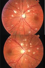 Image result for HIV Retinitis