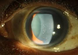 Hsv stromal keratitis without ulceration source: Community Eye Health Journal Herpes Simplex Infection Of The Eye An Introduction
