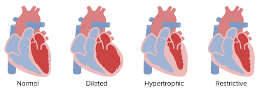 Image result for Cardiomyopathy