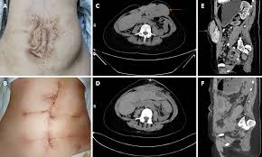 The hernia may not be noticeable unless the patient is crying, pushing to have a bowel movement, or another activity that creates abdominal pressure. Giant Ventral Hernia Simultaneously Containing The Spleen A Portion Of The Pancreas And The Left Hepatic Lobe A Case Report