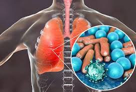 Check spelling or type a new query. Viral Pneumonia Treatment Symptoms Causes