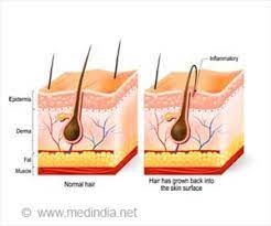 Crush some garlic and make a paste of it then applied the paste over the affected area of ingrown hair, securing it with the help of a bandage and cotton. Top 7 Home Remedies To Get Rid Of Ingrown Hair