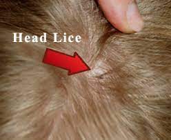 Head lice in blonde hair are no more prevalent than in hair of all other colors, so when it comes to hair that is blonde lice do not prefer one over the other. What Do Lice Look Like The Video Is Kinda Gross But Necessary