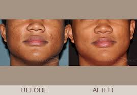 During and after the american civil war, african americans were argued to be a different species from white americans, and many believed that the african americans were doomed to extinction, and arguments were made about their physiology being unsuited for the colder climates of america. Ethnic Skin Dermatologist Paramus Nj Bergen Ridgewood Englewood Passaic Nj