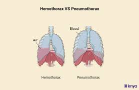 Image result for Pneumothorax