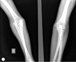 Image result for Radial Head Dislocation