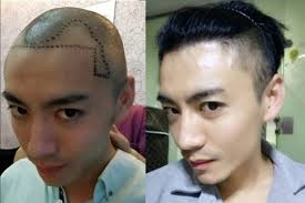 Asian man hair loss treatment one year post op result hair transplant restoration by dr diep. Millennial Chinese Men Going Bald Younger Getting Hair Transplants To Restore Their Locks And Confidence South China Morning Post