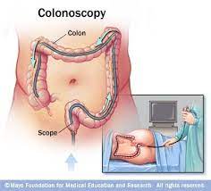 Colonoscopy Cancer Diagnosis Colonoscopy Microscopic Colitis