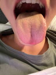 Image result for yellow tongue infection