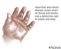 Image result for Hand foot and mouth disease HFMD roof of mouth