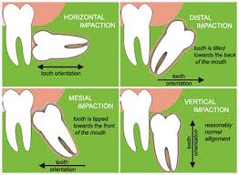 Learn more in this article. What Are The Consequences Of Not Getting Your Wisdom Teeth Removed Quora
