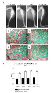Traditionally, cancer in dogs is treated similarly to cancer in humans, with three basic types of but even if your dog is diagnosed with terminal cancer, there are plenty of options to ensure a happy chemotherapy is a common treatment to help slow the spread of the disease—as left untreated, the. How Long Can You Live With Bone Cancer Untreated