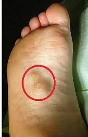 See full list on foothealthfacts.org Plantar Fibromatosis Aka Ledderhose Disease Foot Pain Explored
