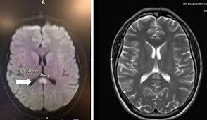 Image result for High Altitude Edema