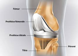 J'ai eu une prothèse de genou droit le 9 février2012, à ce jour j'ai toujours du mal à marcher et à plier mon genou, mais en ce moment les douleurs sont de plus en plus fortes et j'ai l'impression d'avoir mon genou dans un étau avec aussi. Prothese Du Genou Clinique Du Mousseau