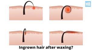 An ingrown hair occurs when a shaved or tweezed hair grows back into the skin. Bad Ingrown Hairs After Brazilian Wax Kobo Guide