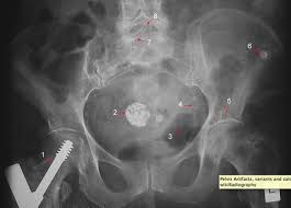 Xray Artifacts Flashcards Quizlet