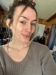 How to get rid of facial scars and reduce round face with PCOS?