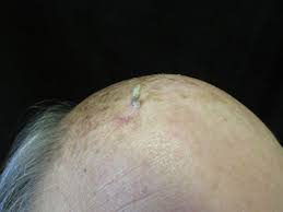 Image result for cornu cutaneum)