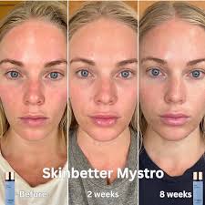 April is #RosaceaAwarenessMonth. Over 16 million Americans live with this  chronic skin condition that causes redness, visible blood vessels, bumps,  flare-ups, and even eye irritation that can be triggered by stress, weather,