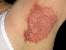 It occurs in skin folds, where skin rubs against other skin. Intertrigo Dermnet Nz