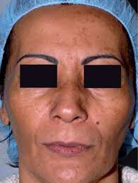 Grátis: FOTOPROTETOTES E DESPGMENTANTES